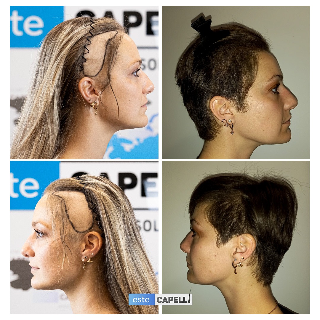 Before and after result