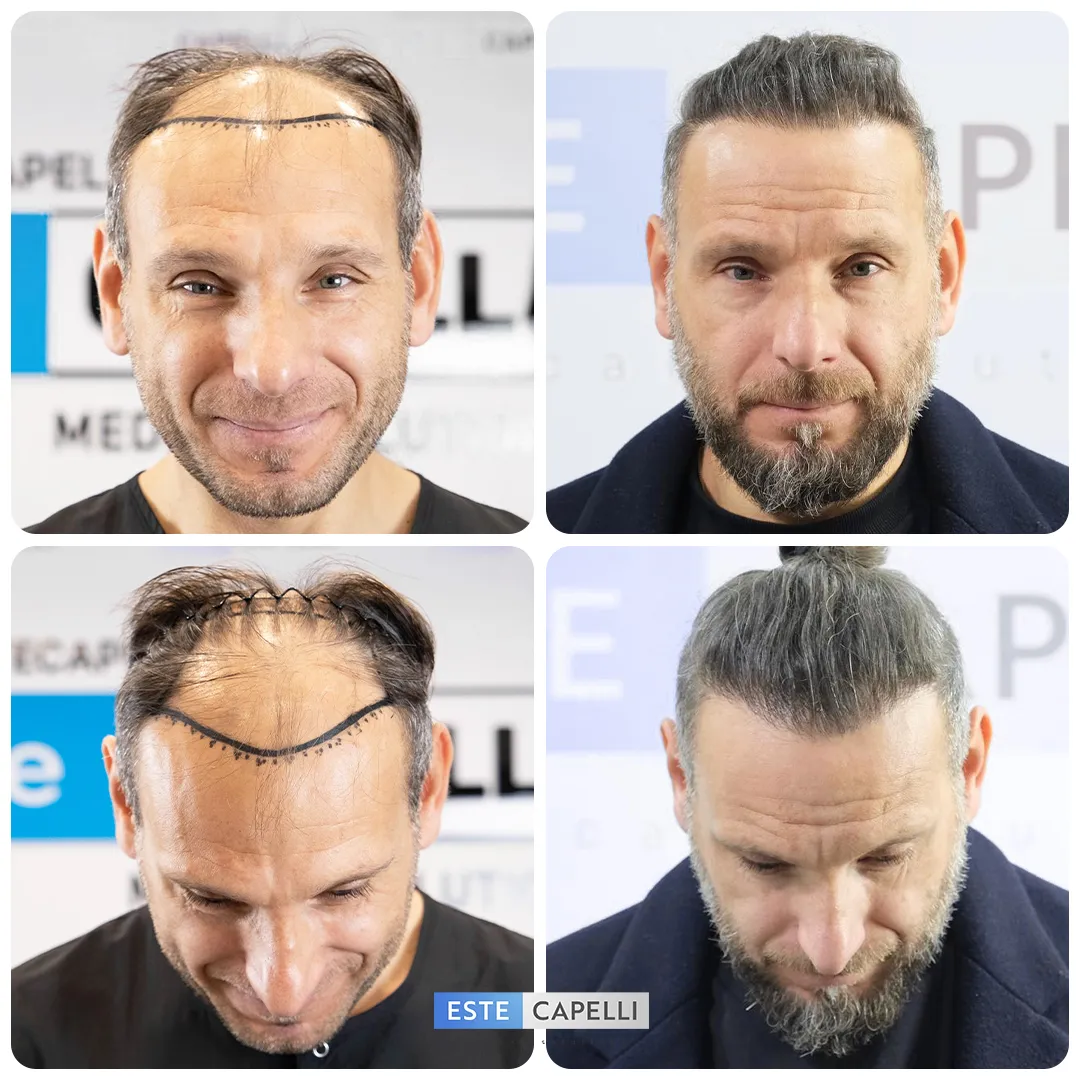 Before and after result