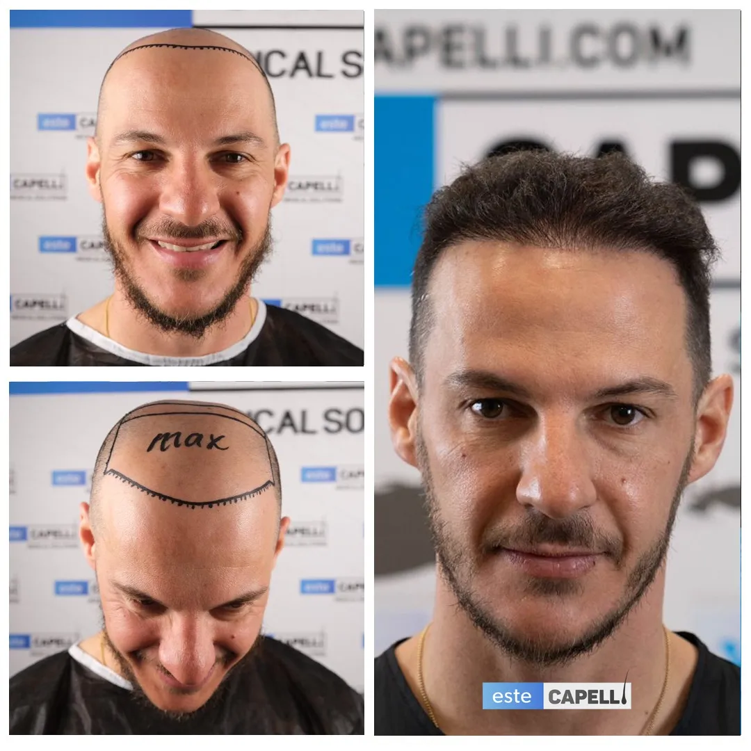 Before and after result