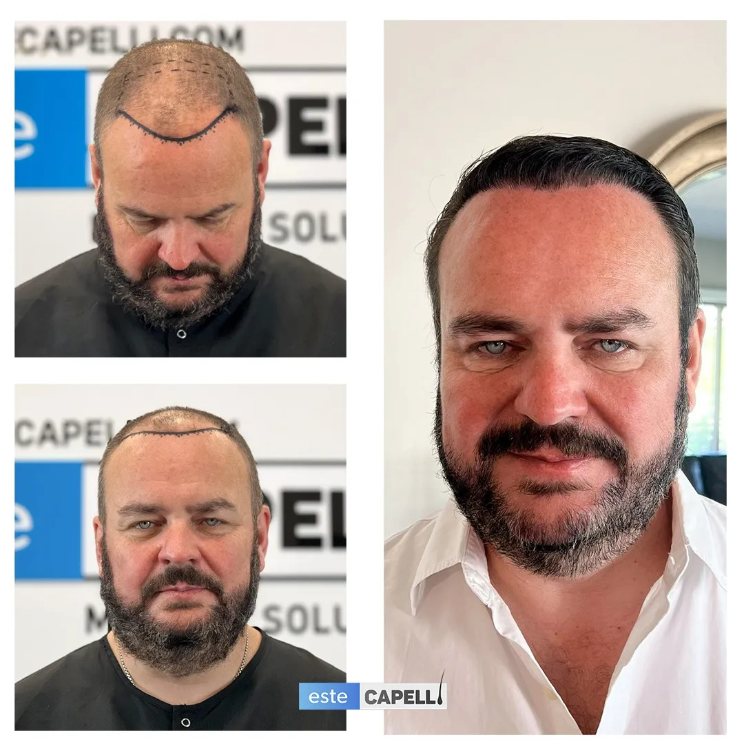 Before and after result