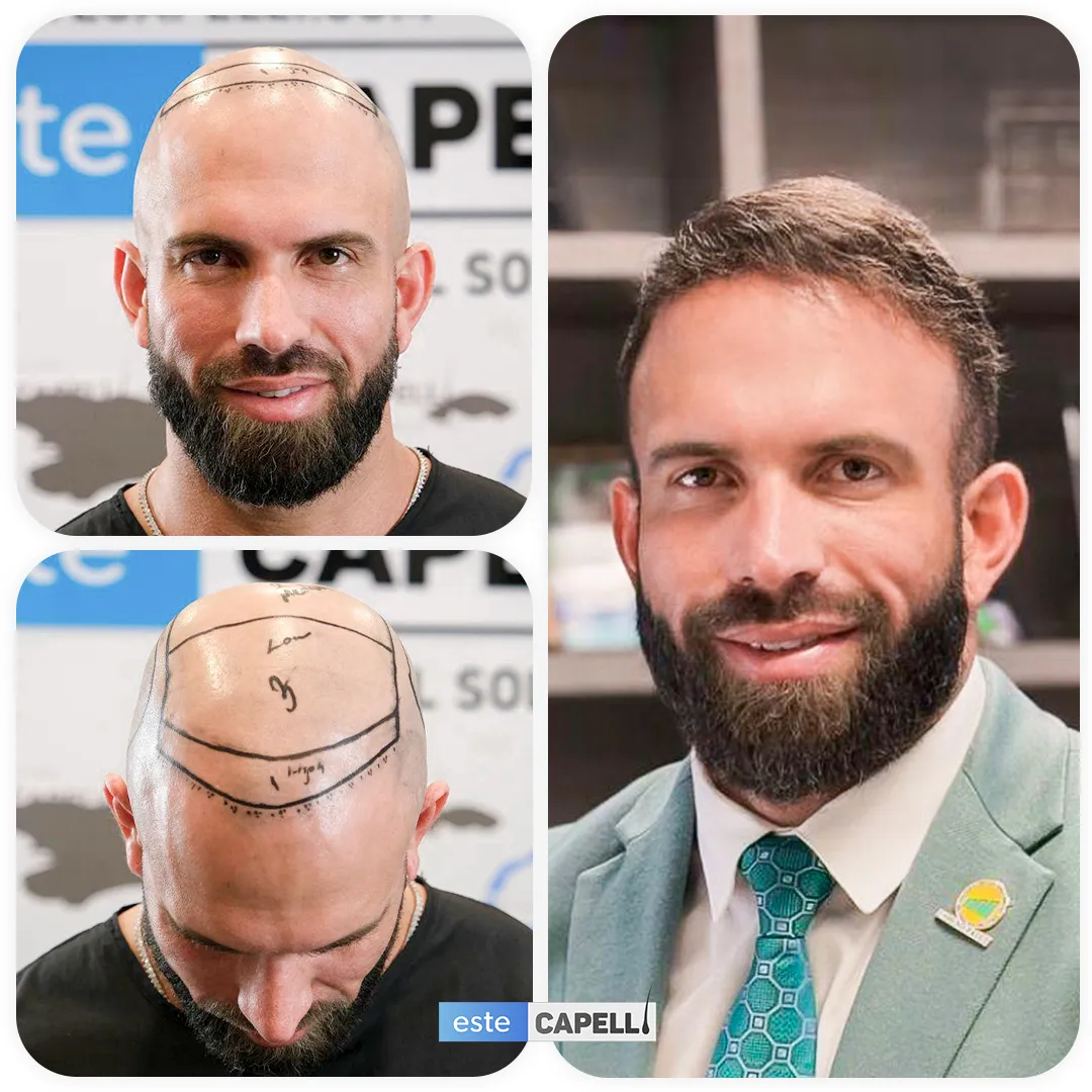 Before and after result