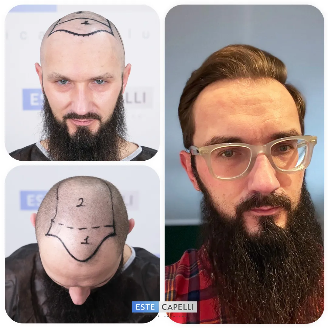 Before and after result