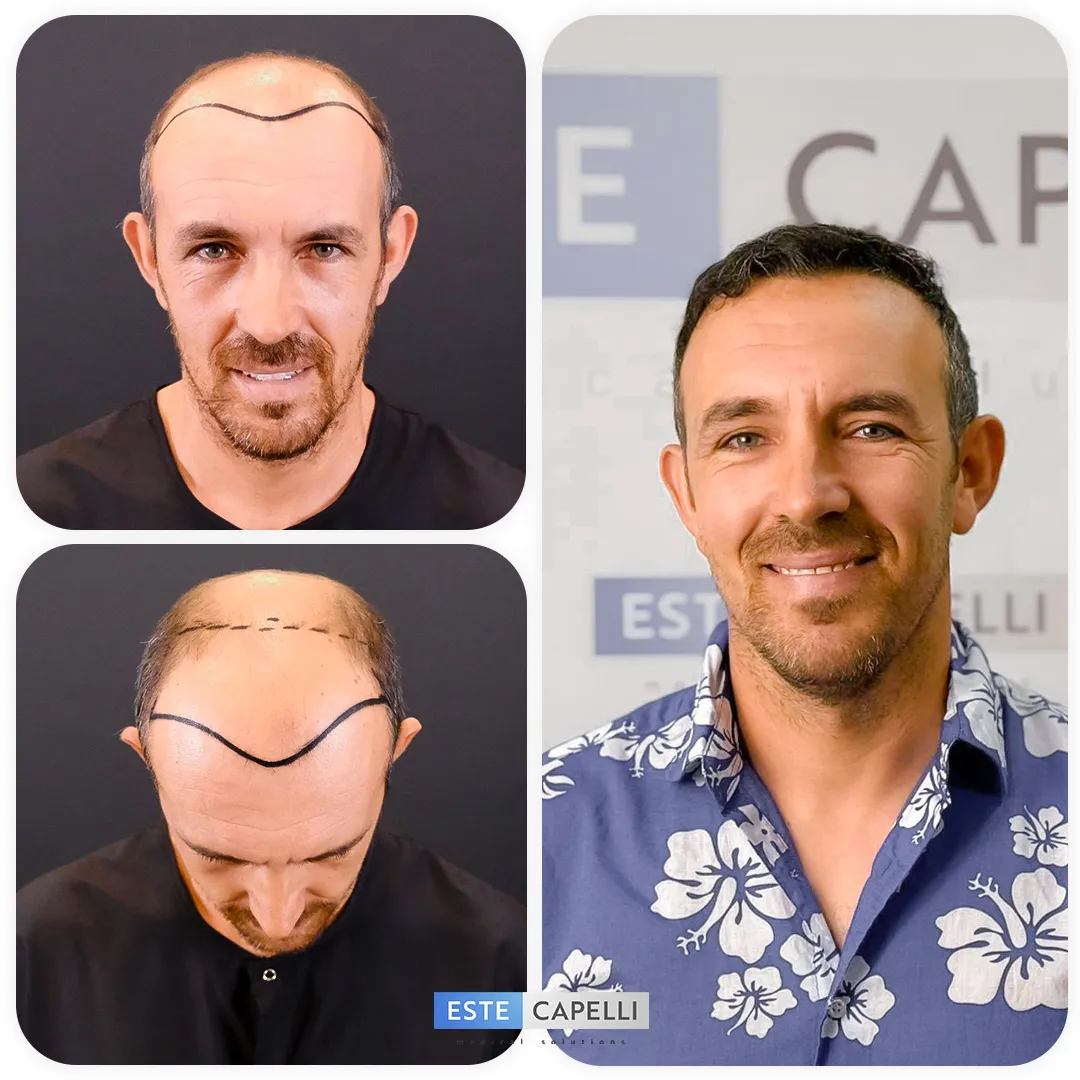 Before and after result