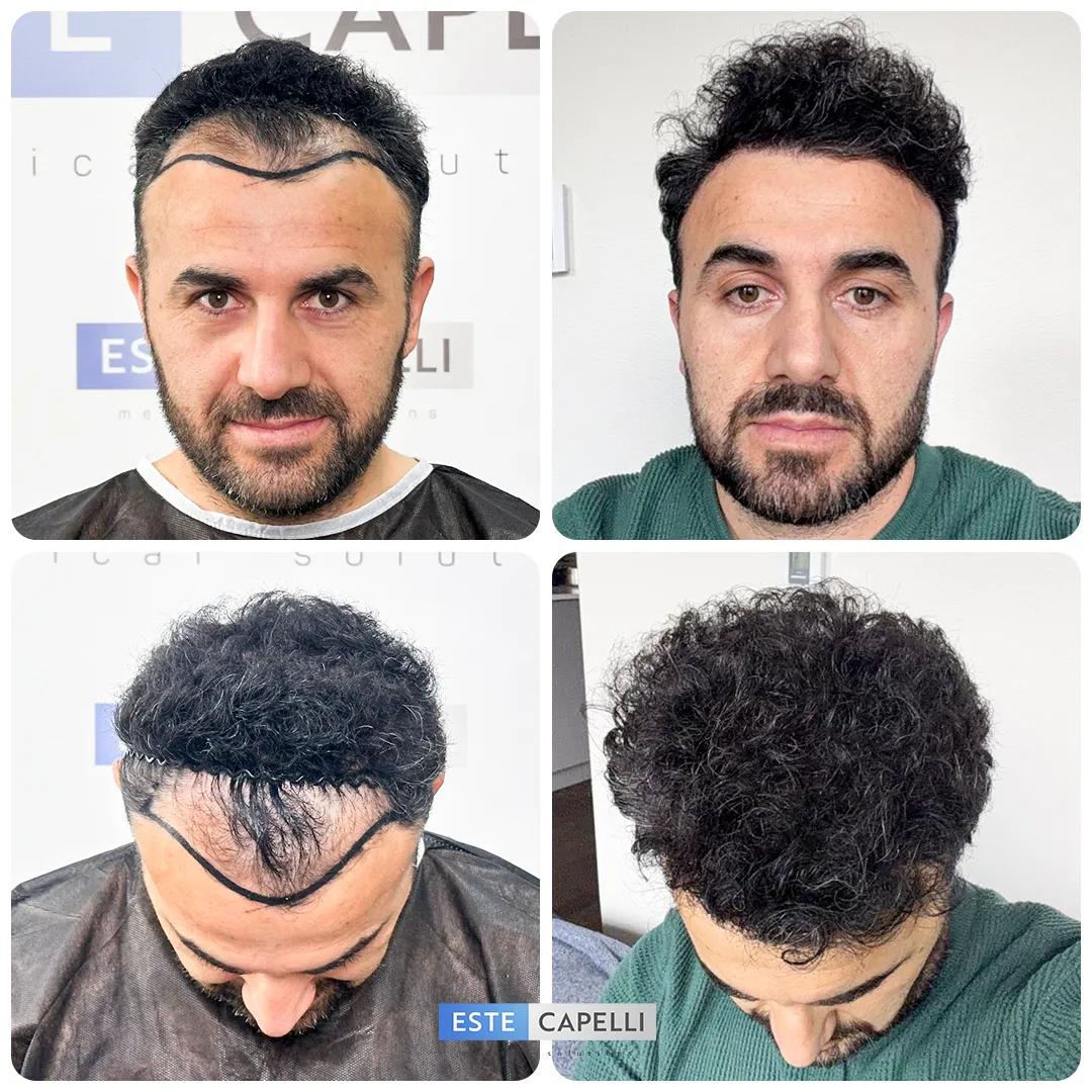 Before and after result