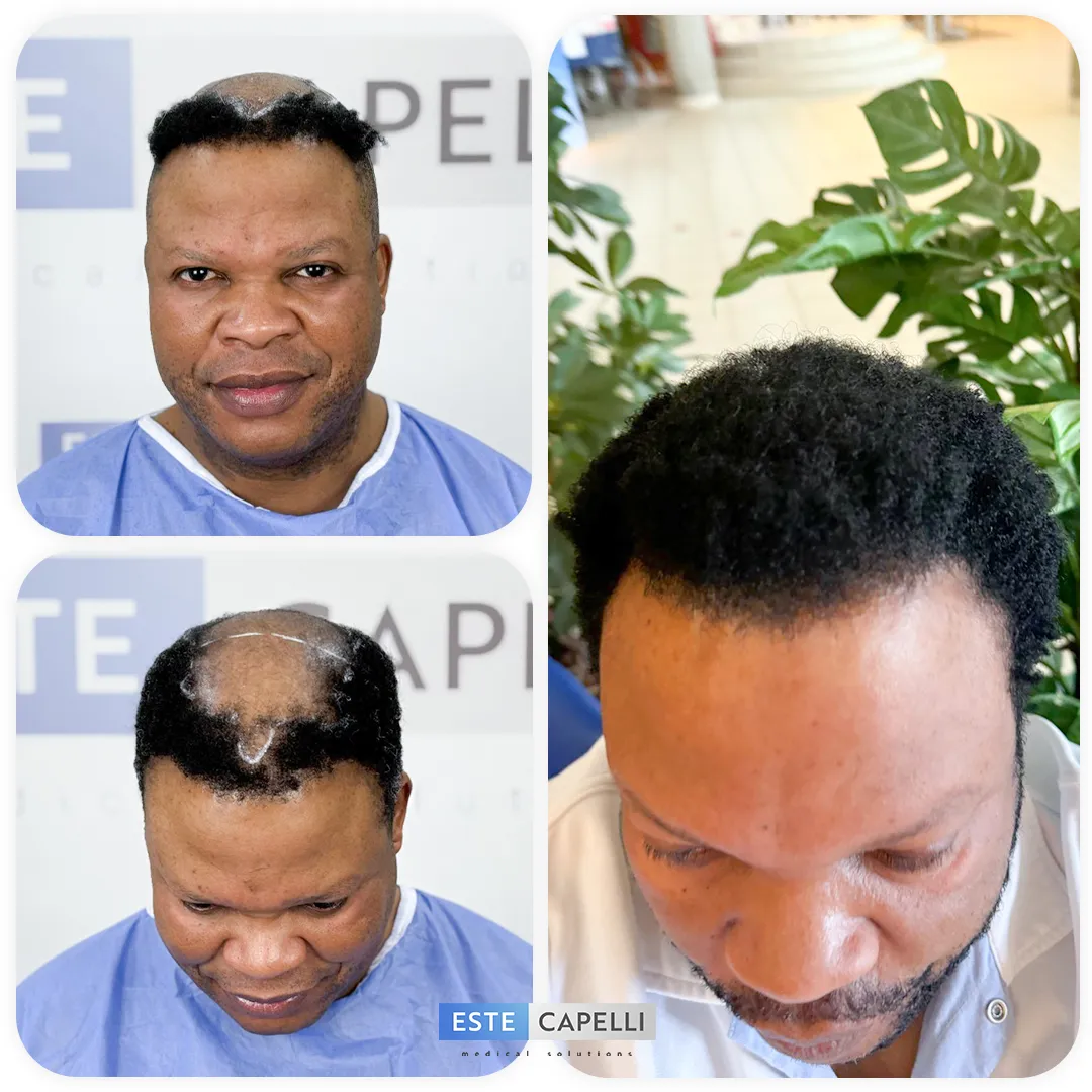 Before and after result