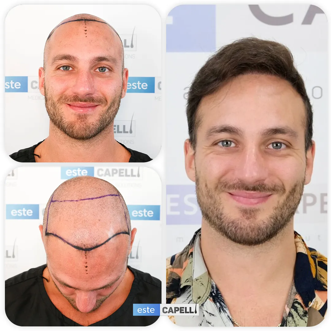 Before and after result