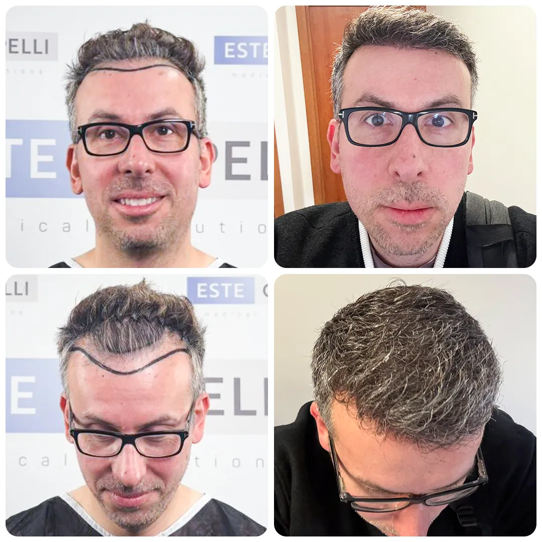 Before and after result