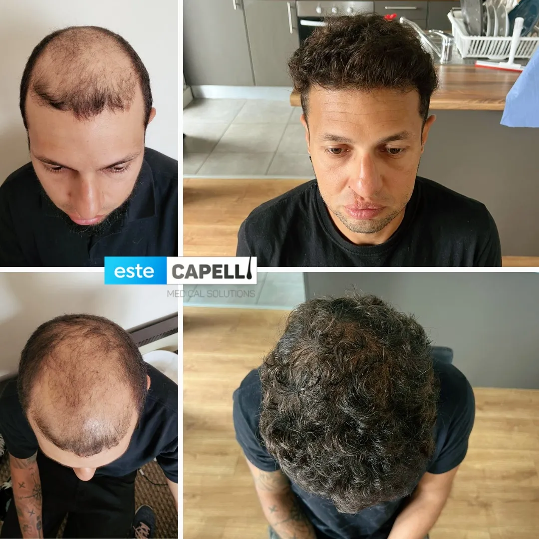 Before and after result