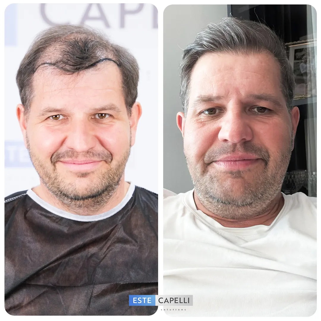 Before and after result