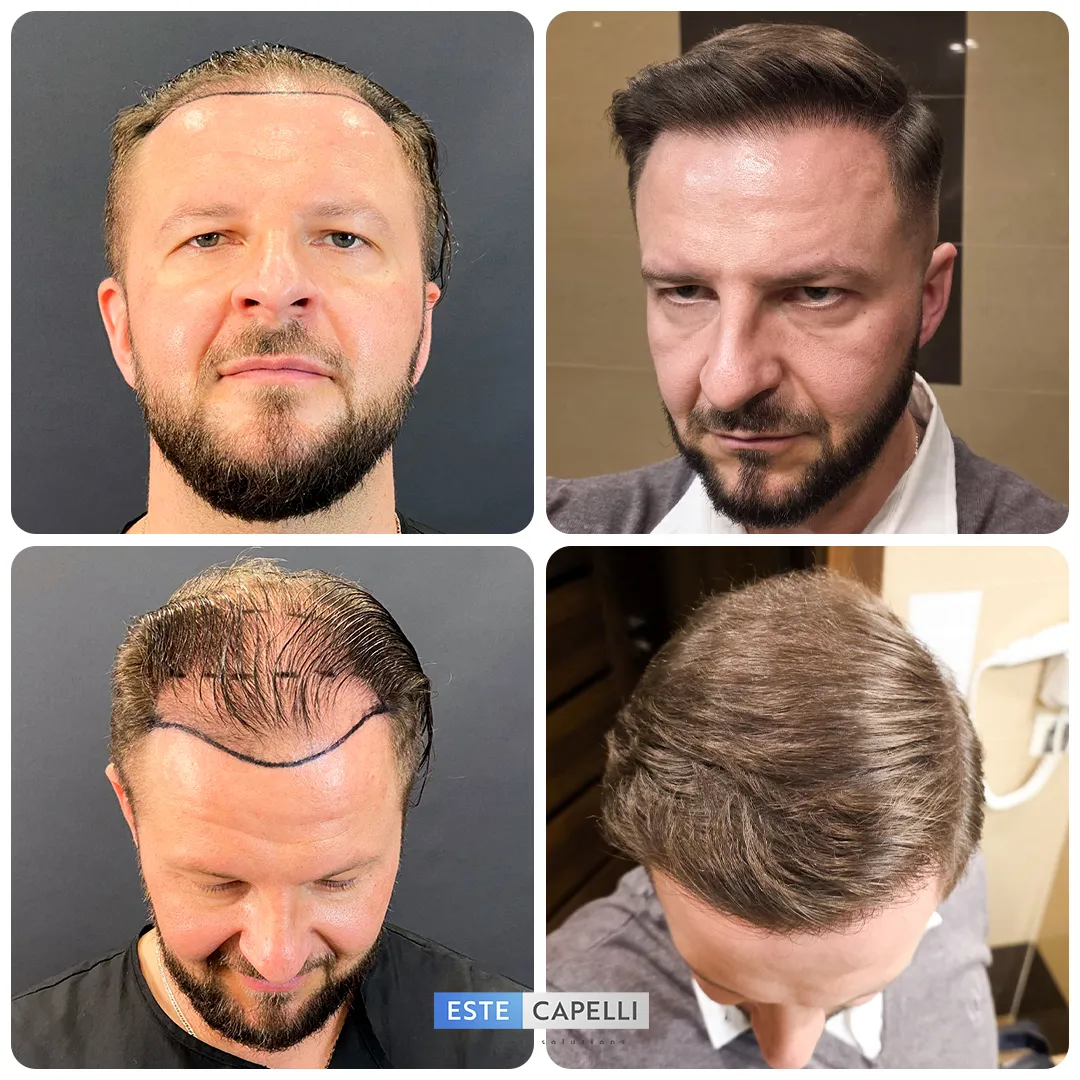 Before and after result