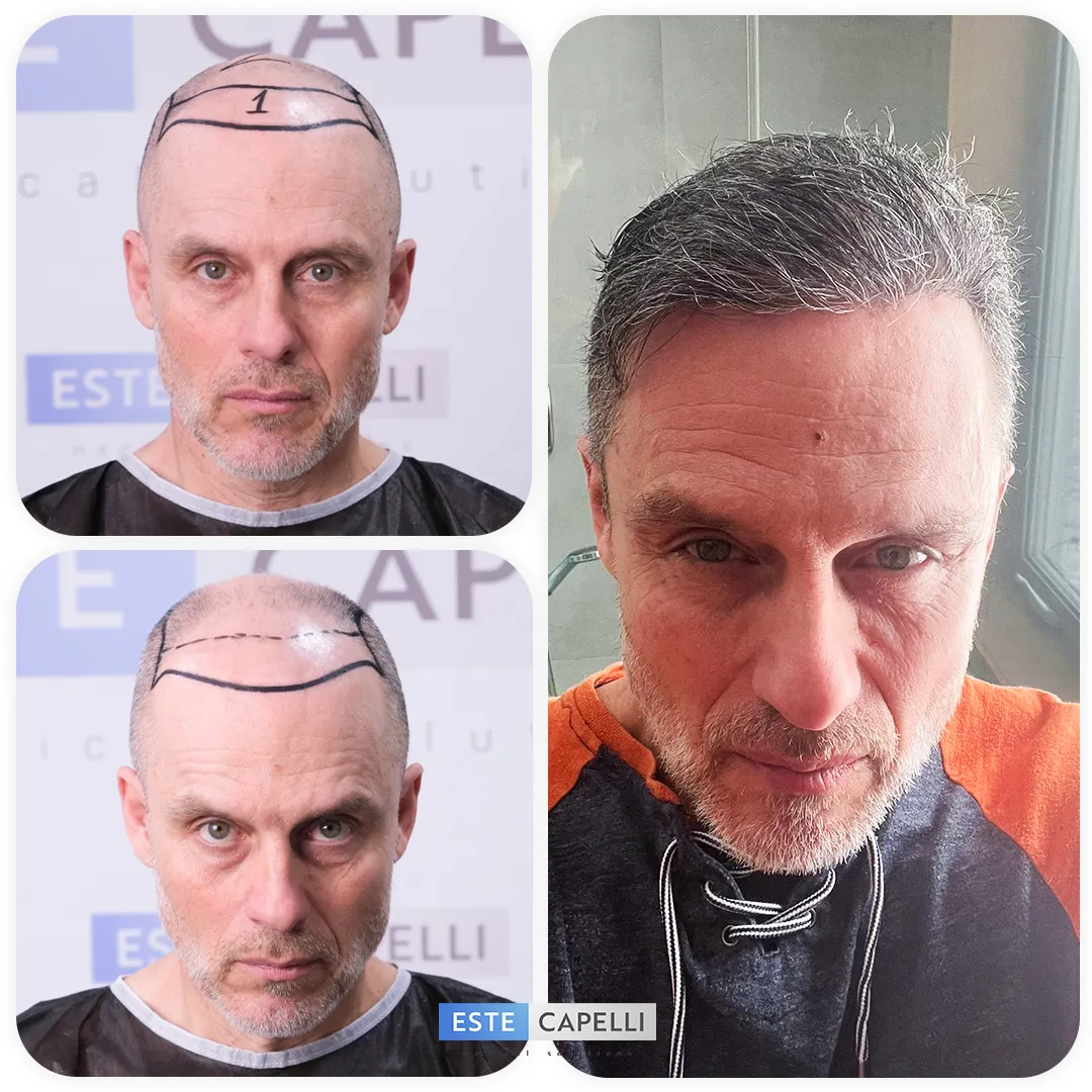 Before and after result