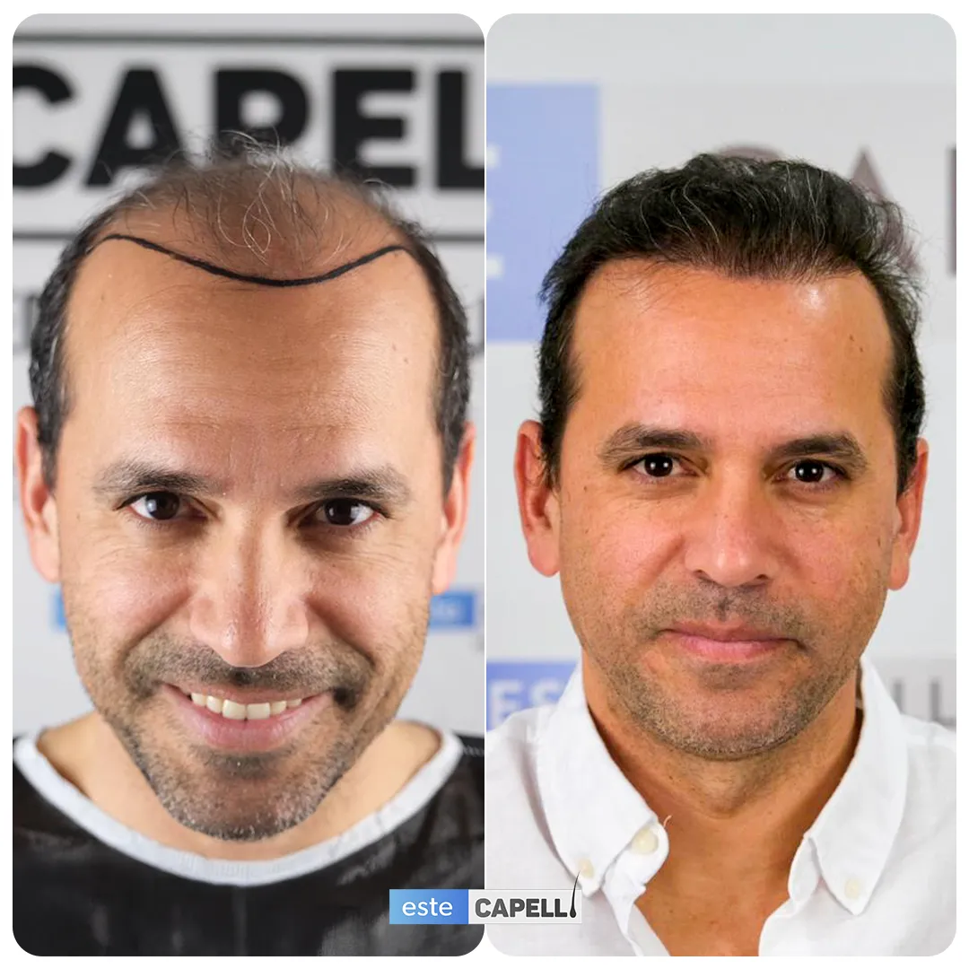 Before and after result