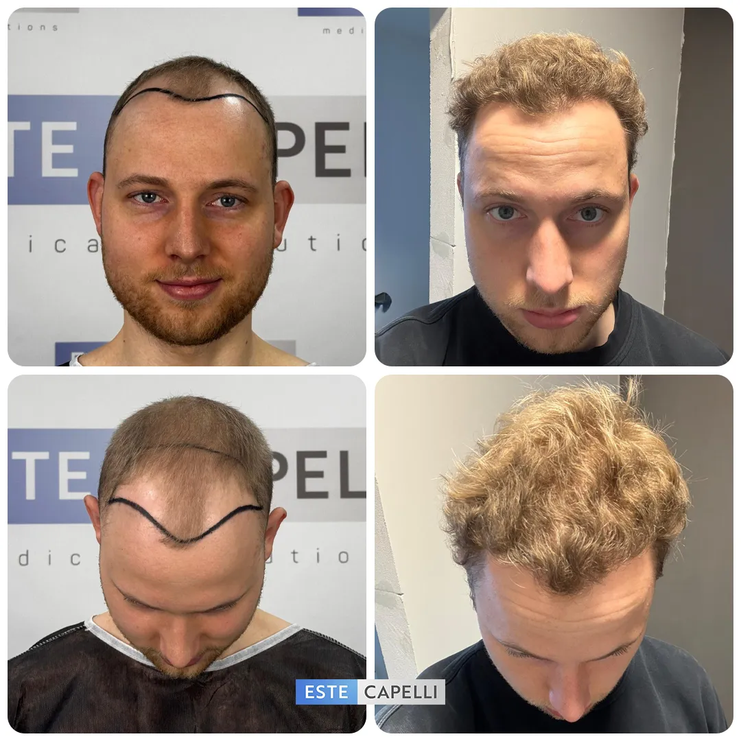 Before and after result