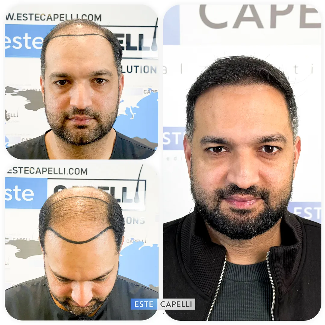 Before and after result