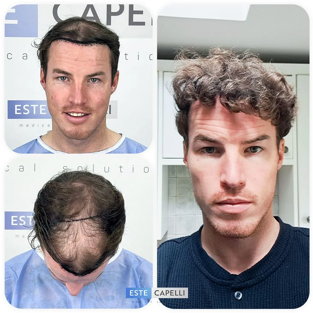 Before and after result