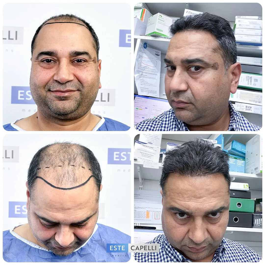 Before and after result