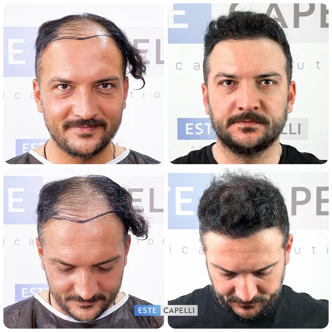 Before and after result