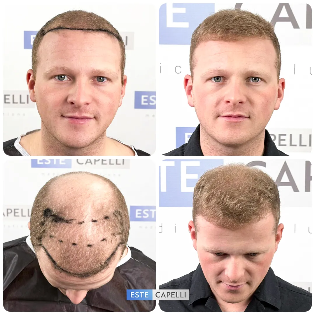 Before and after result