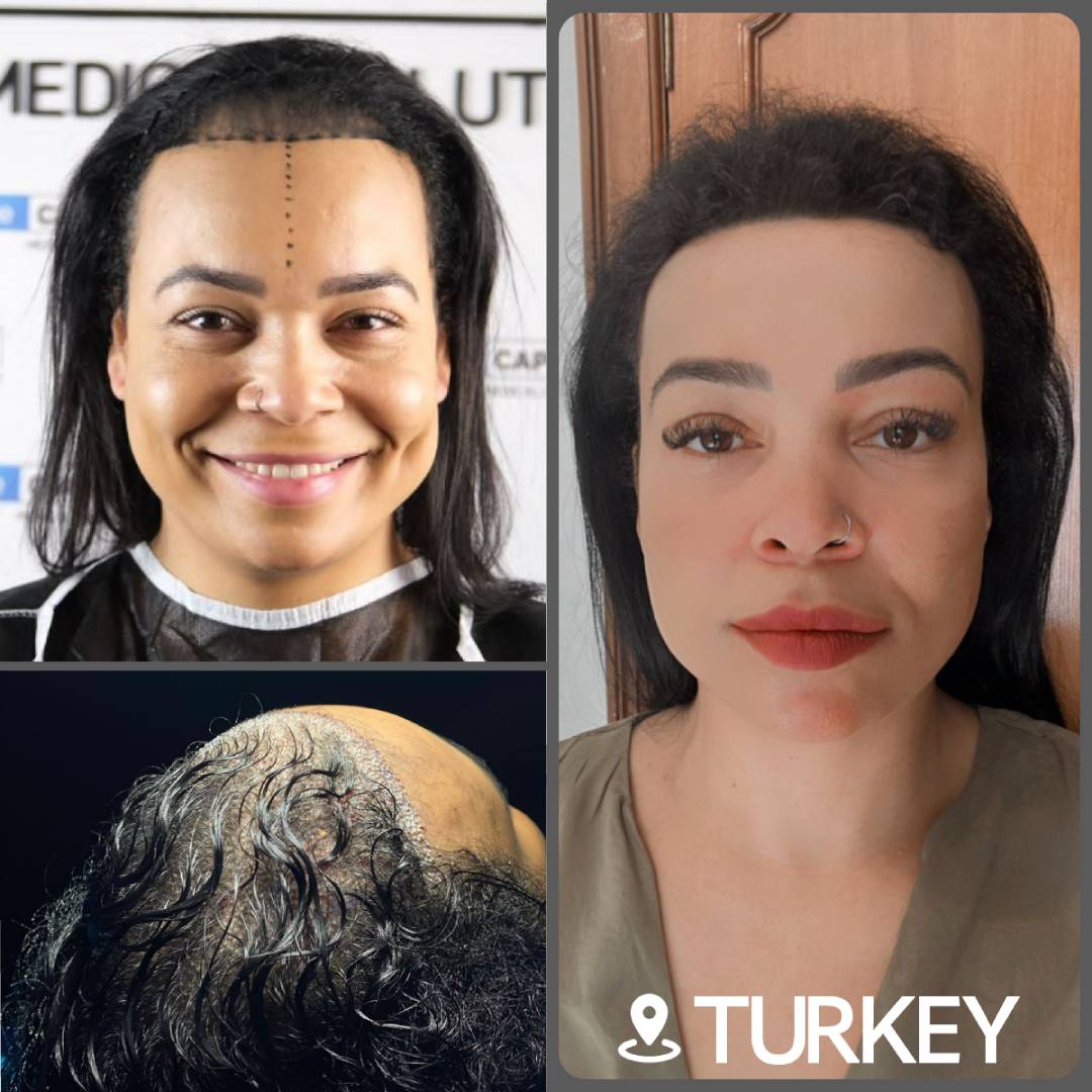 Before and after result