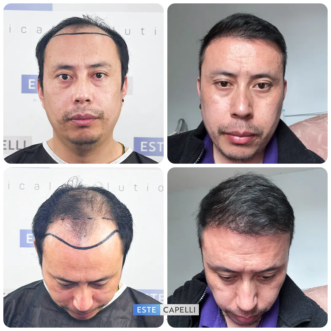 Before and after result