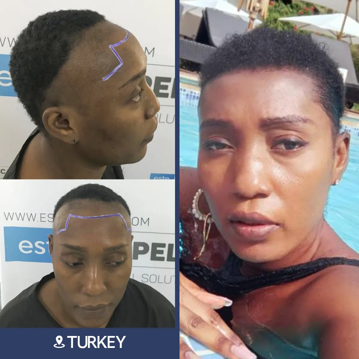 Before and after result