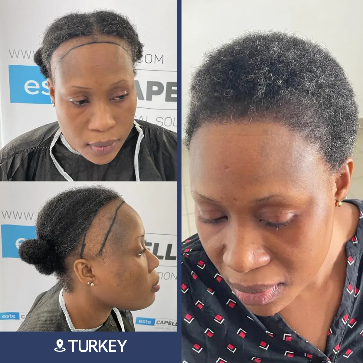 Before and after result