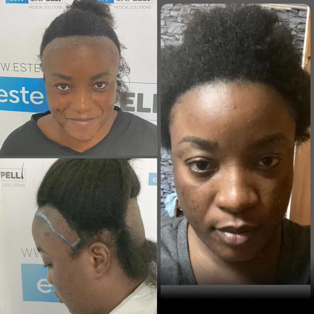 Before and after result
