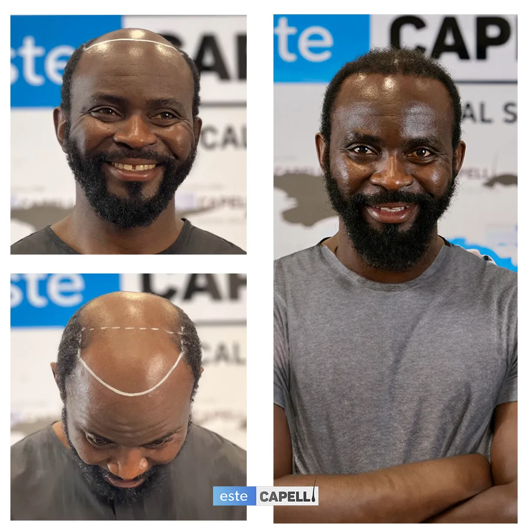 Before and after result