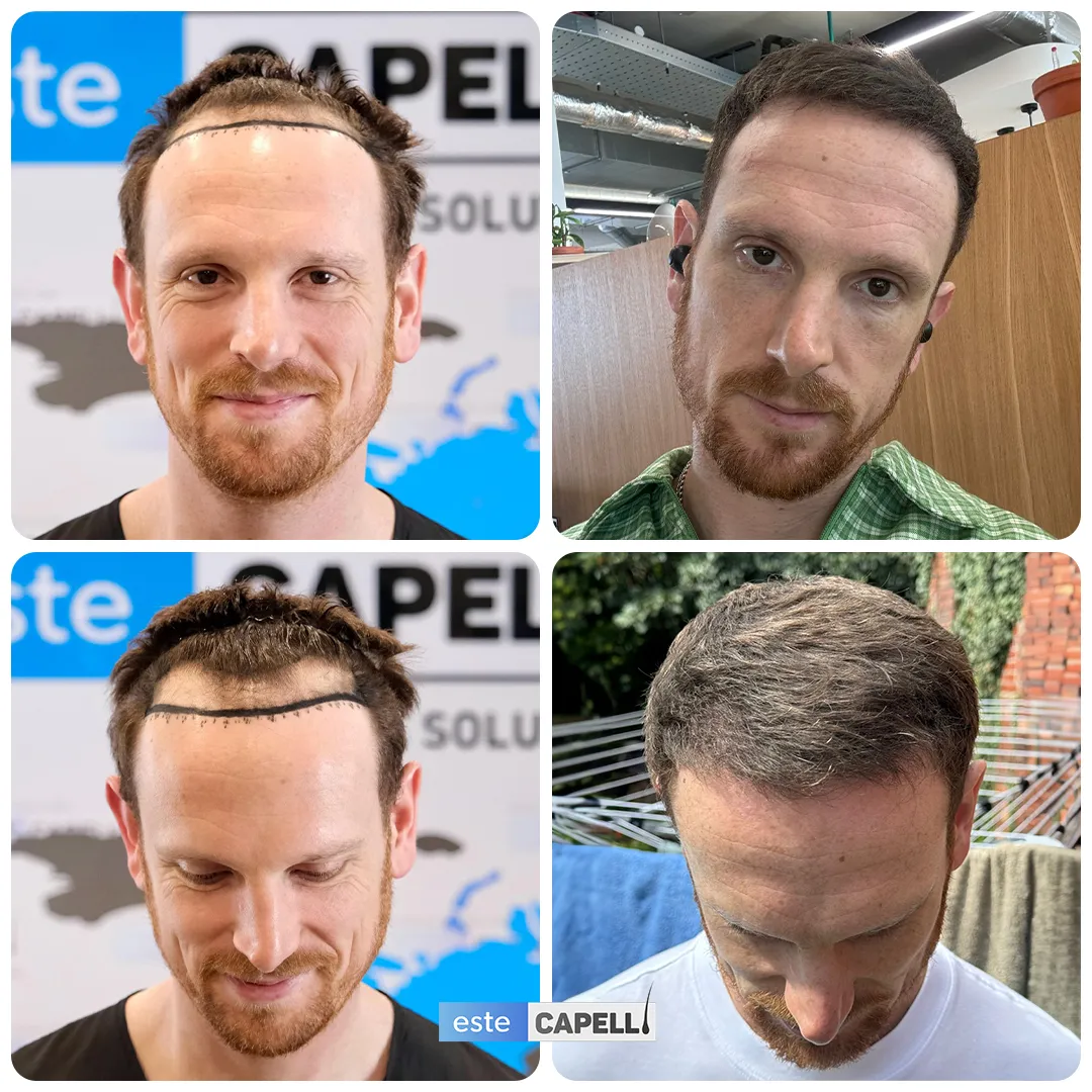 Before and after result