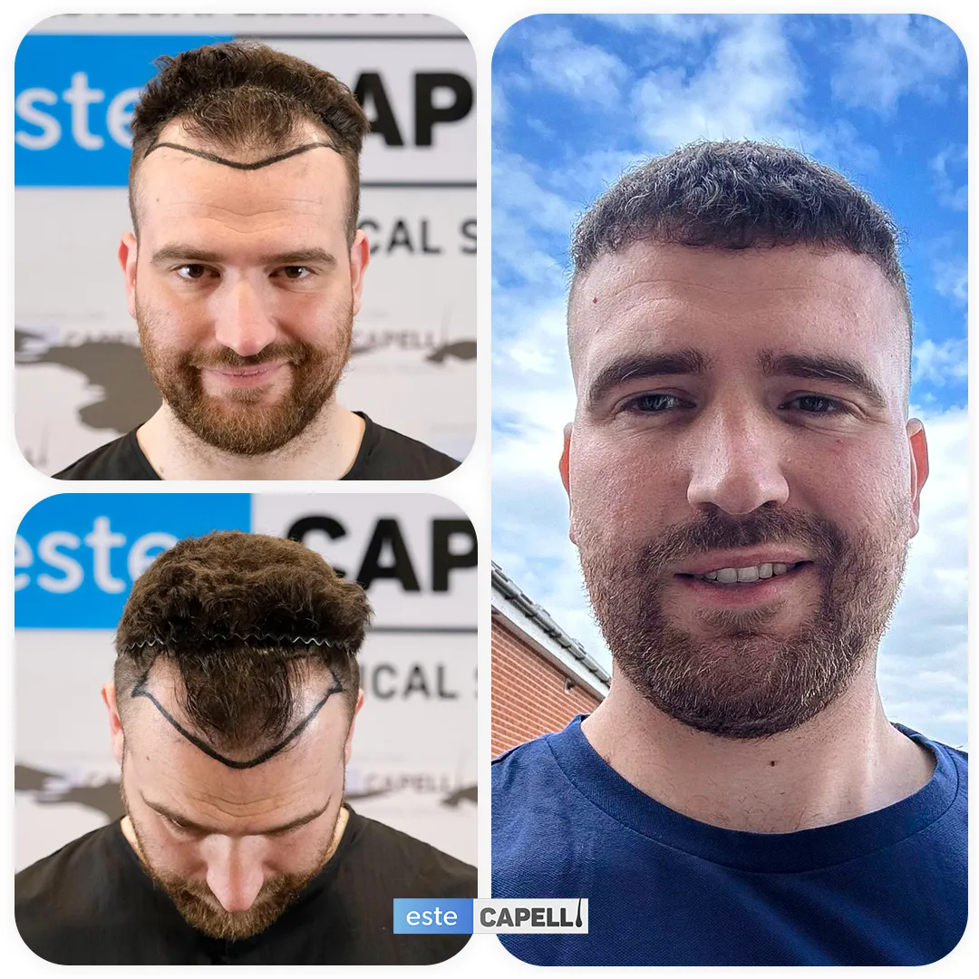 Before and after result
