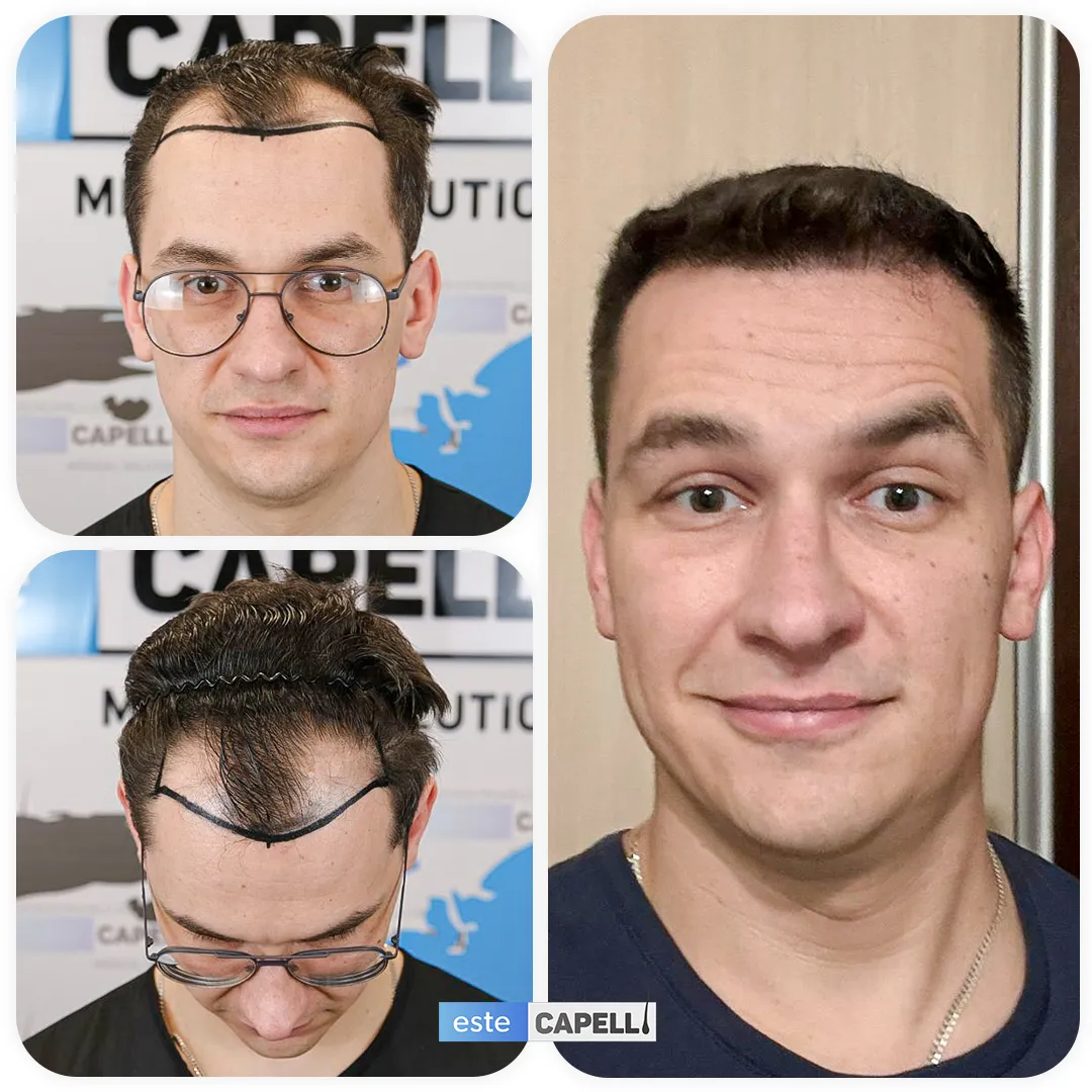 Before and after result