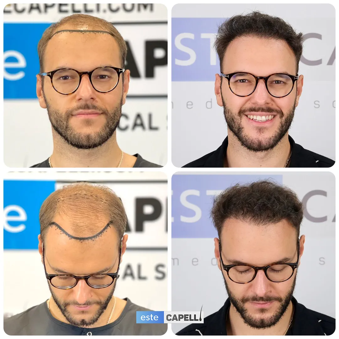 Before and after result