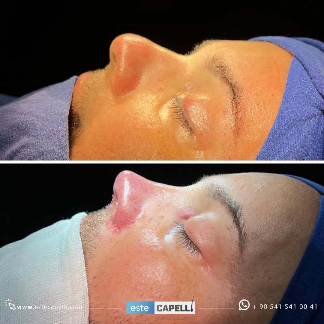 Before and after result