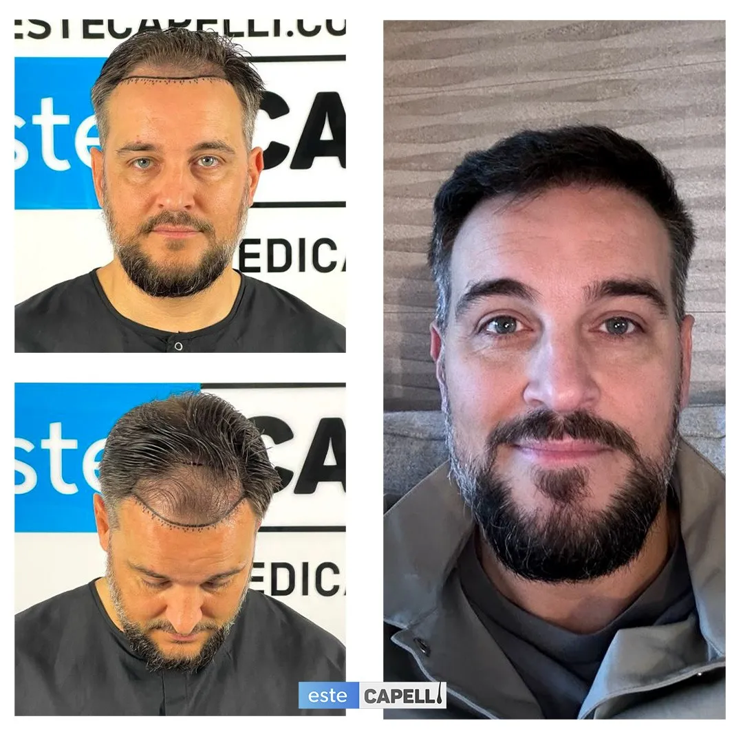 Before and after result