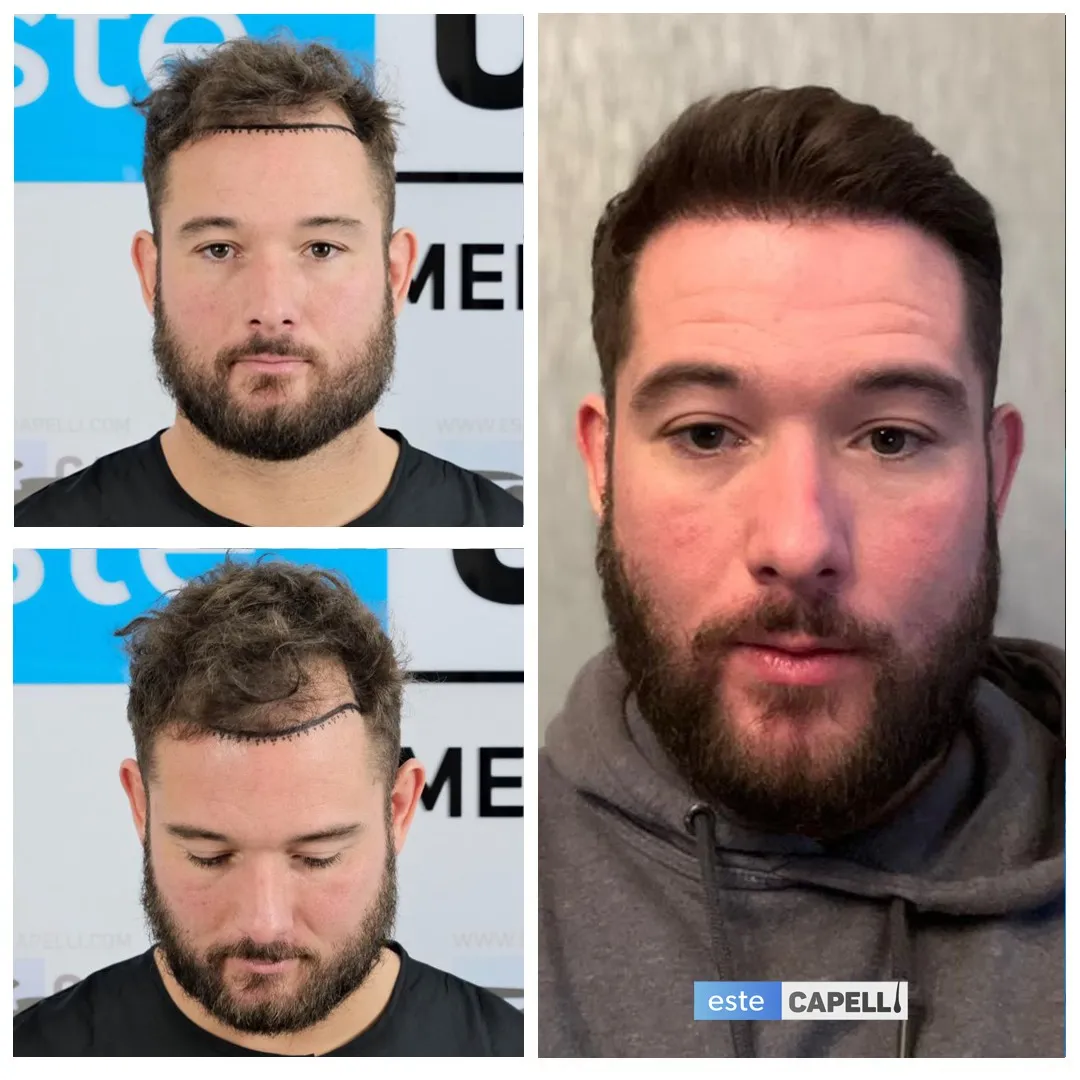 Before and after result