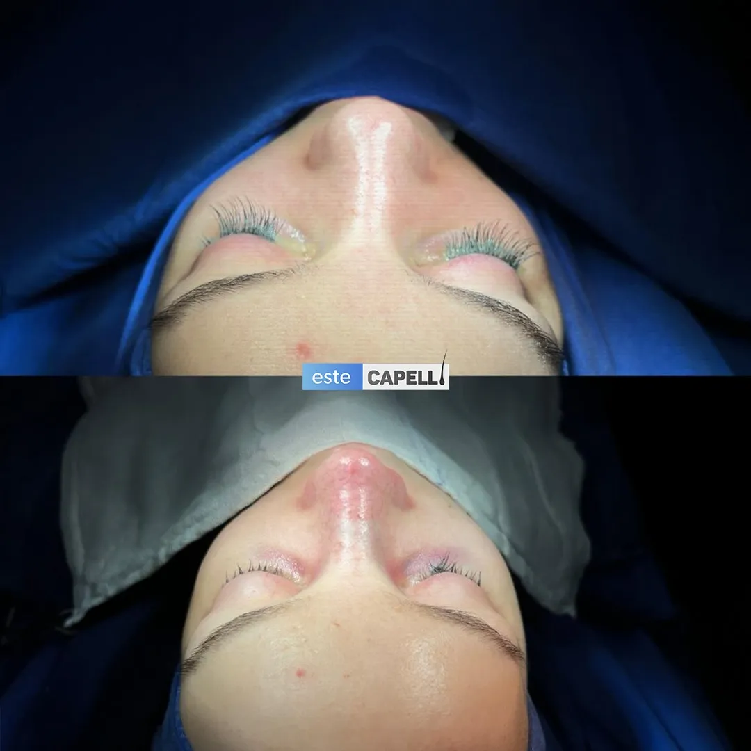 Before and after result