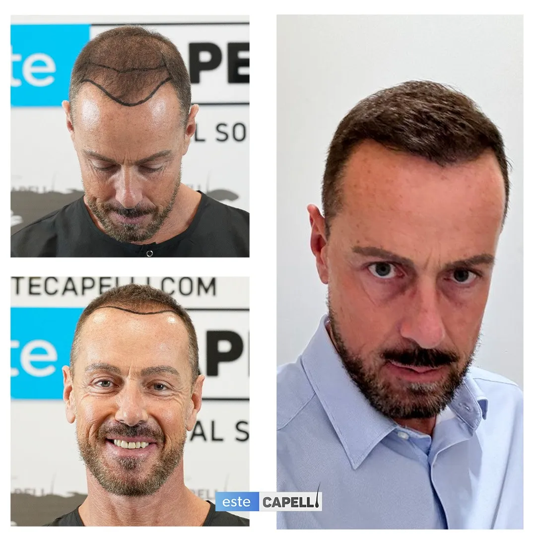 Before and after result