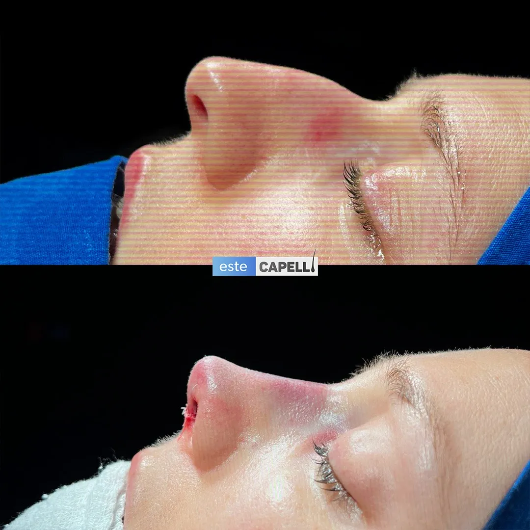 Before and after result