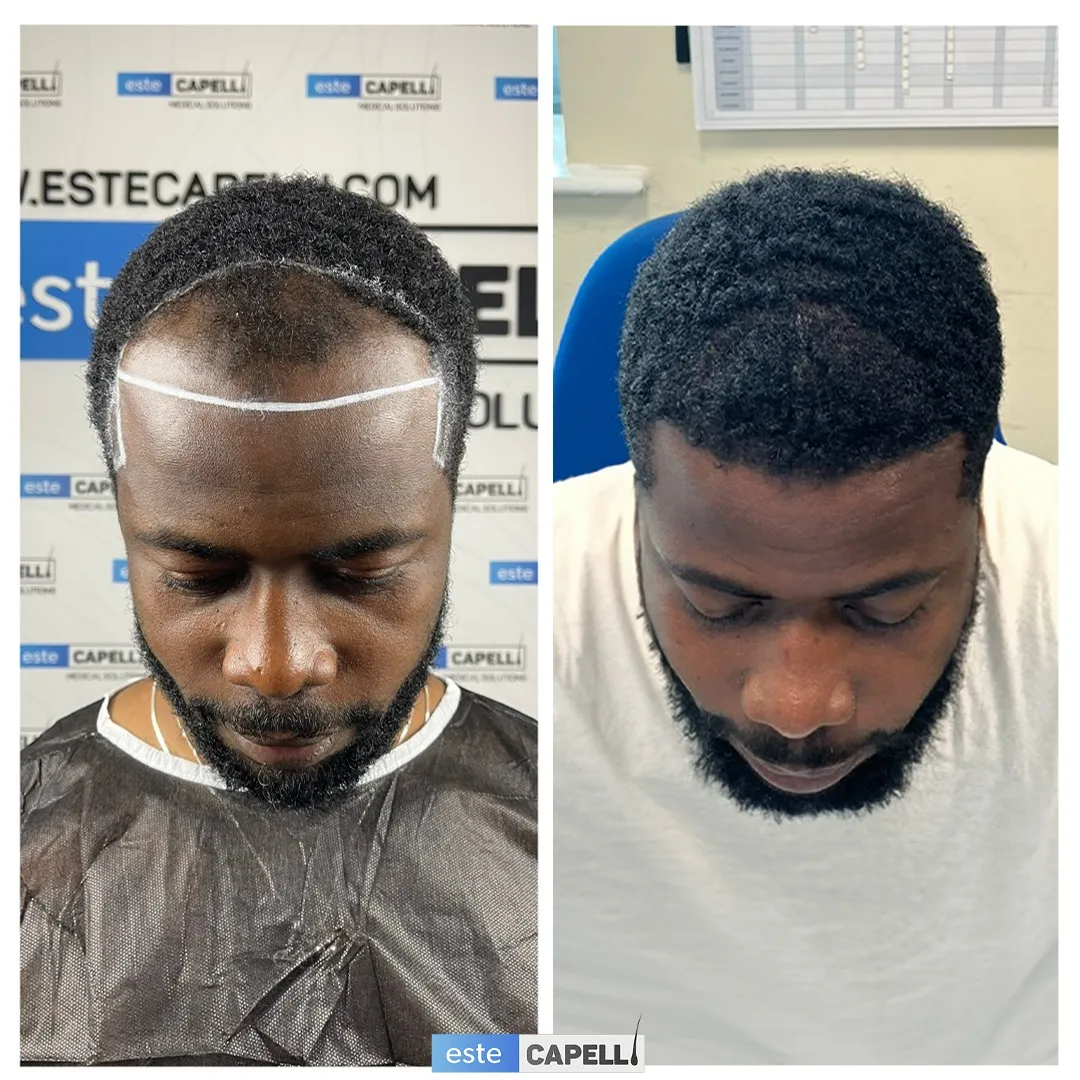 Before and after result