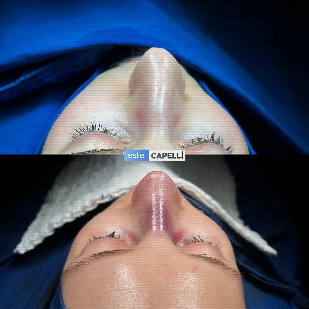 Before and after result