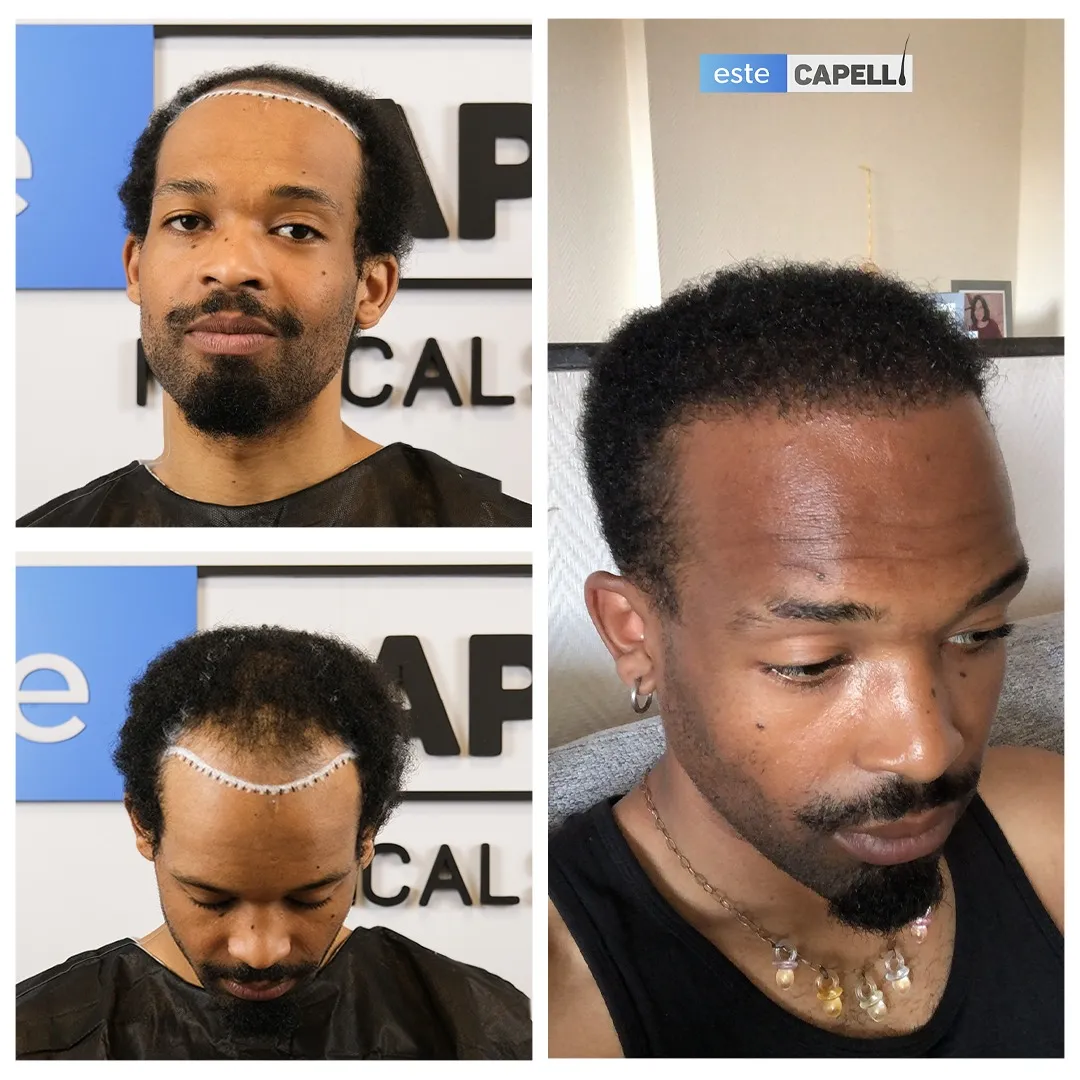 Before and after result