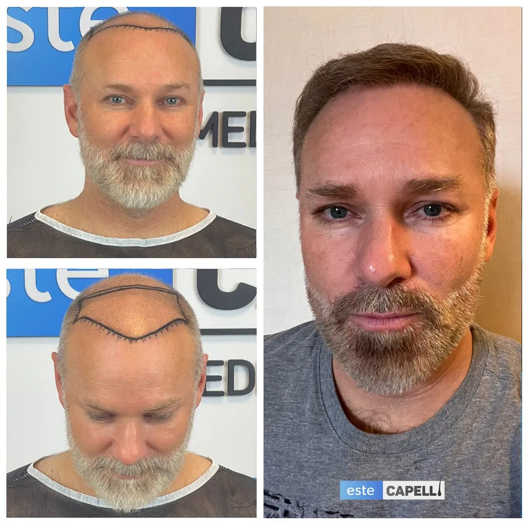 Before and after result