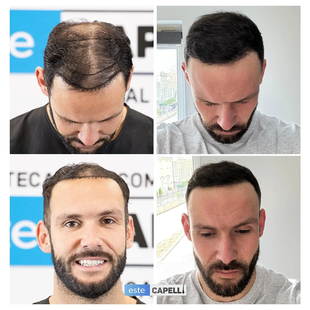 Before and after result
