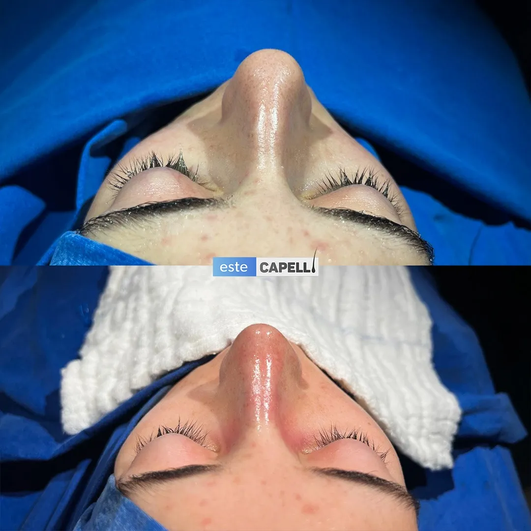 Before and after result
