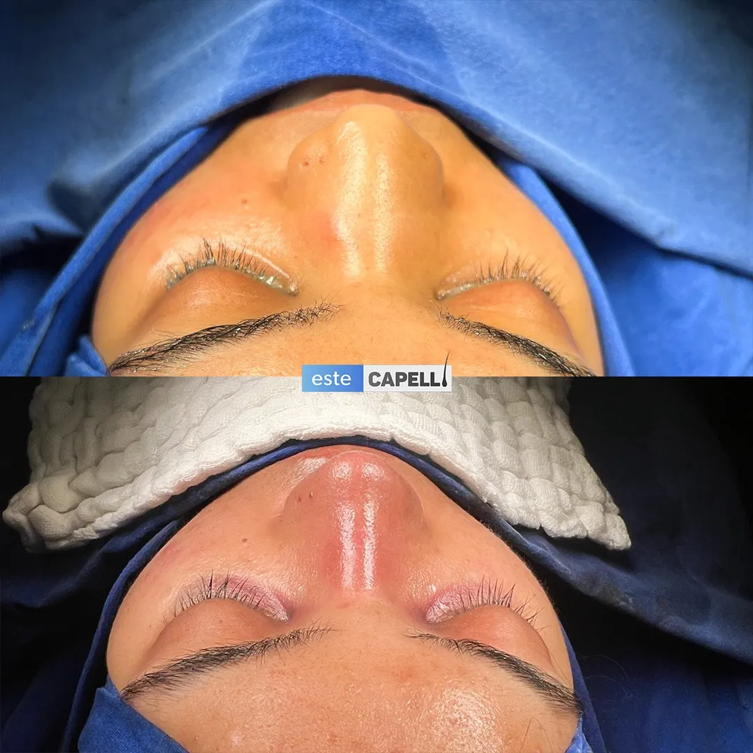 Before and after result