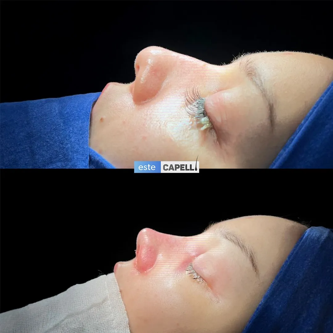 Before and after result