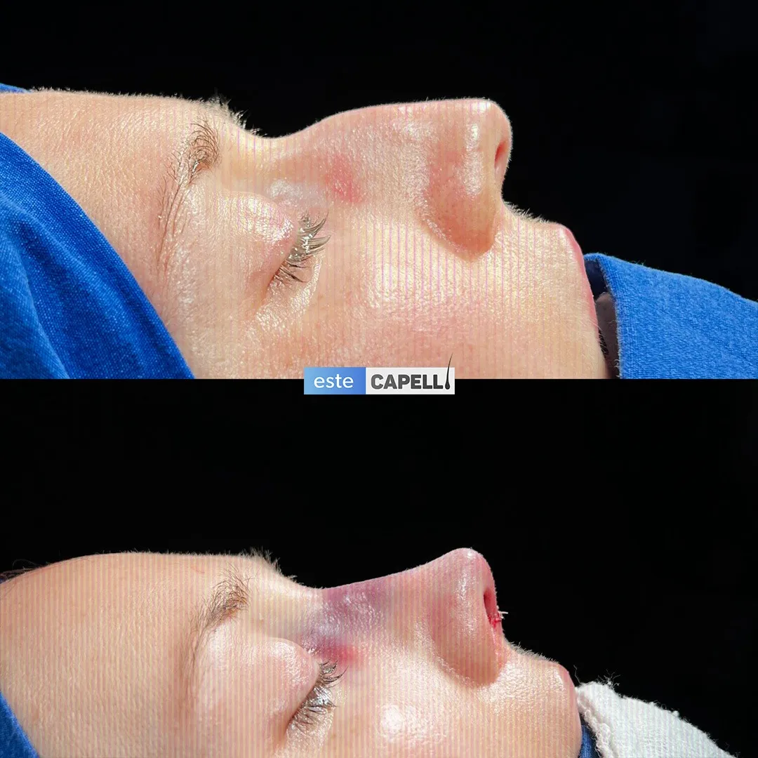 Before and after result