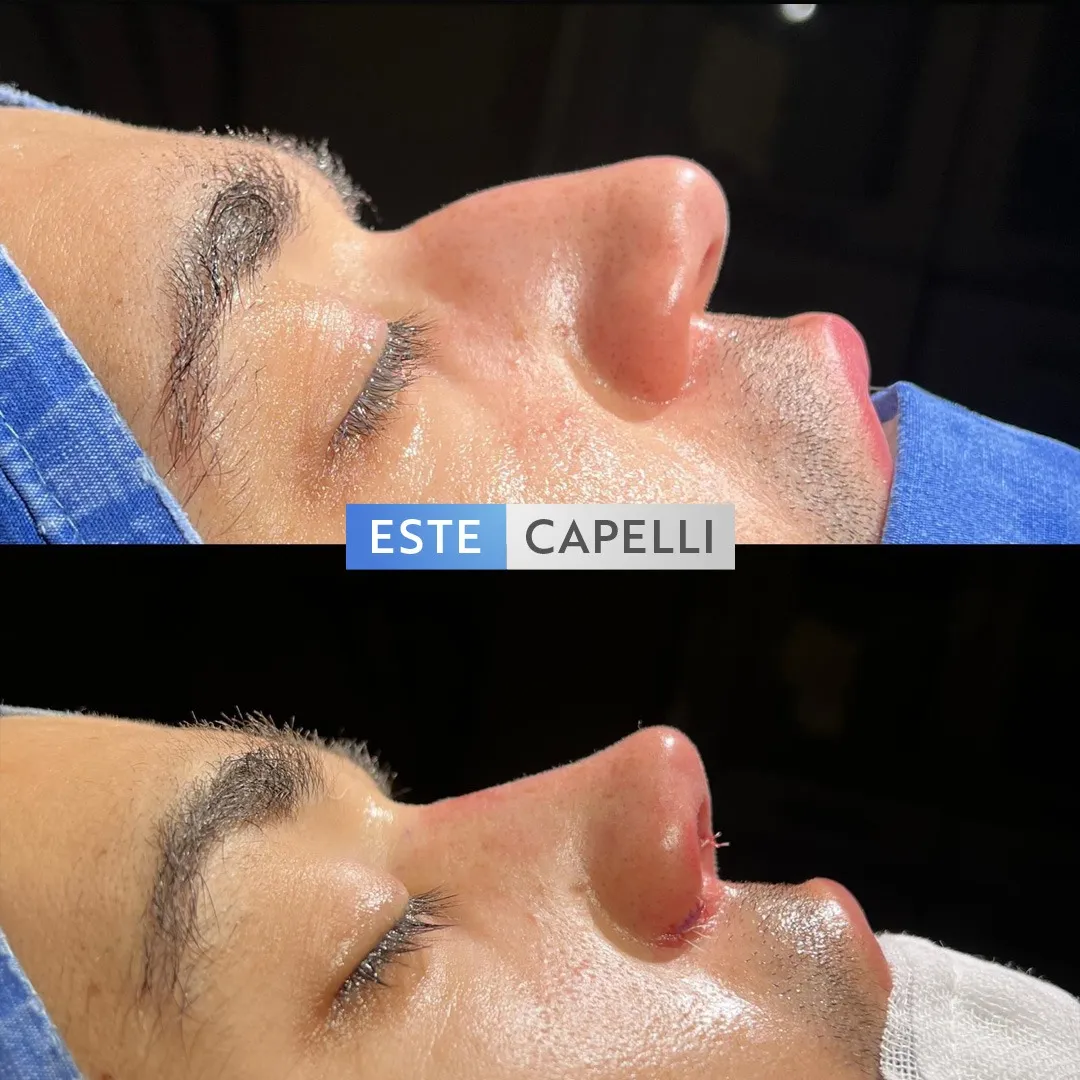 Before and after result
