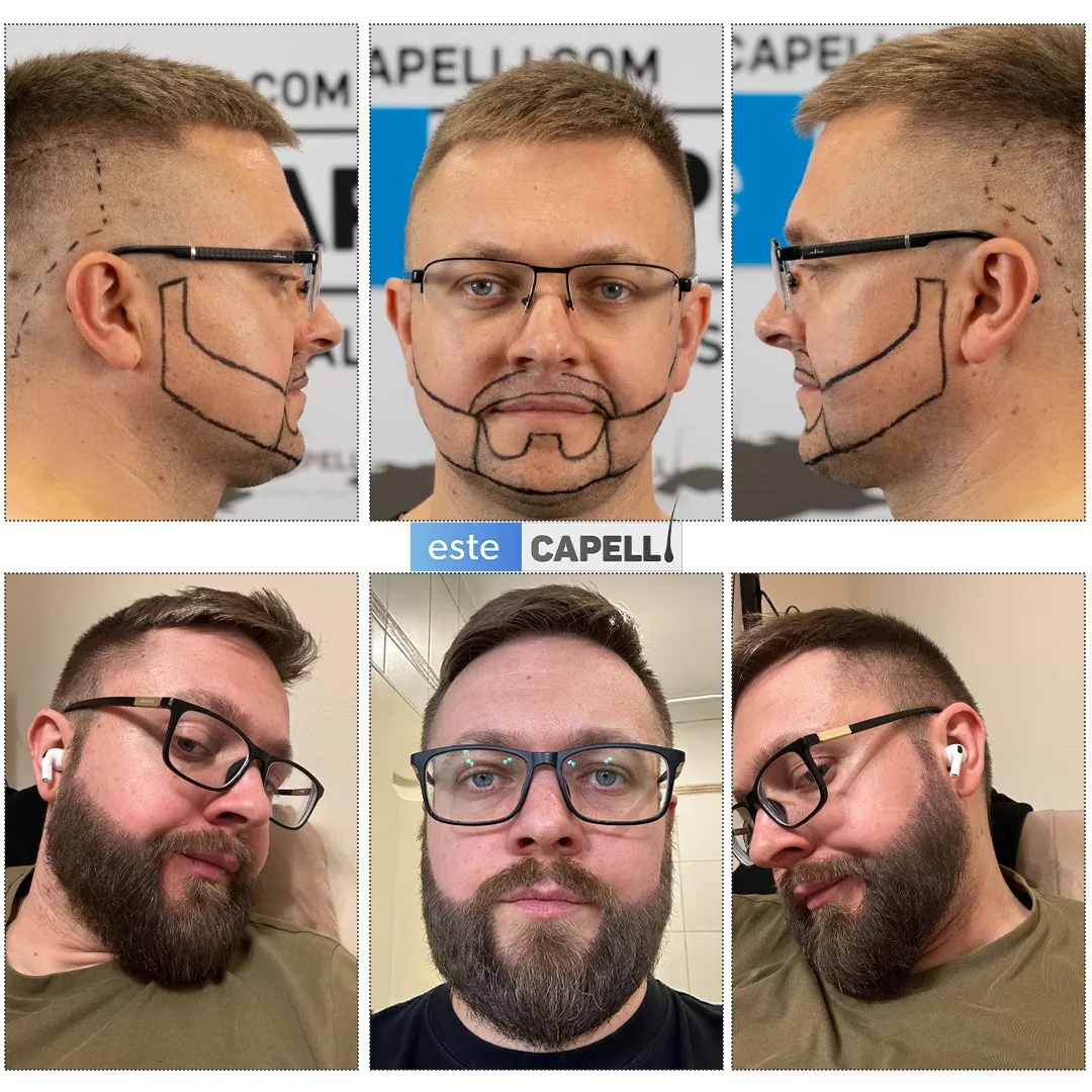Before and after result