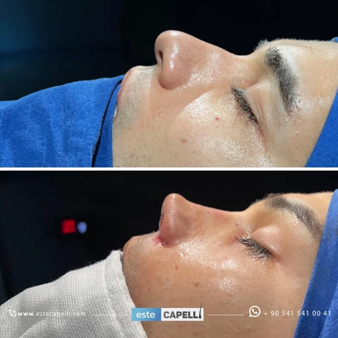 Before and after result